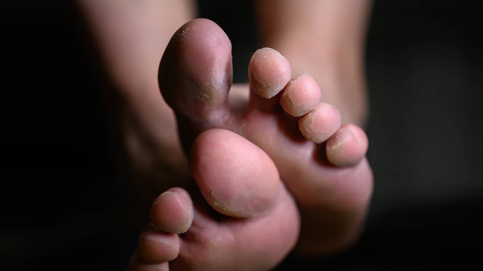 7 Causes of Stinky Feet (and How to Fix It) | Power of Positivity