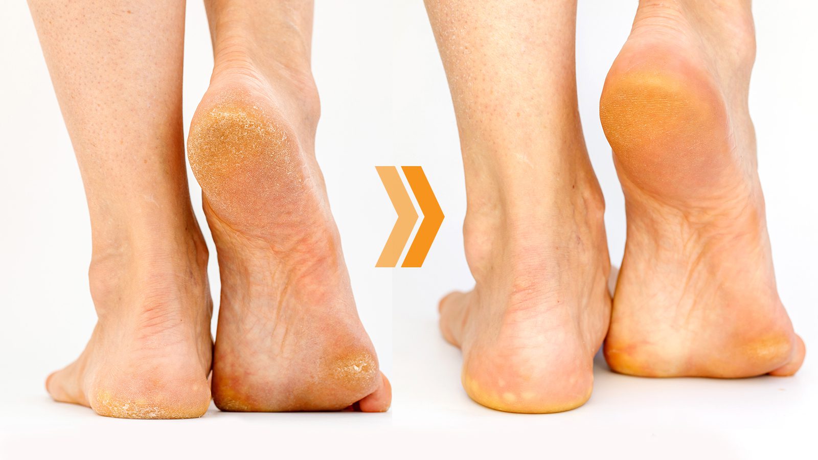How to Heal Cracked Heels - In Awe Australia