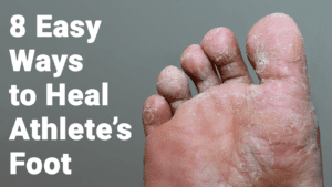 tea tree oil to treat athlete's foot