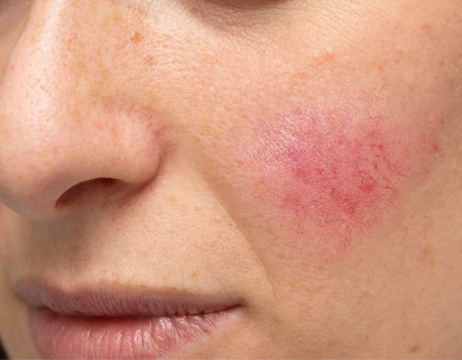 Rashes That Could Reveal A Dermatologic Disease